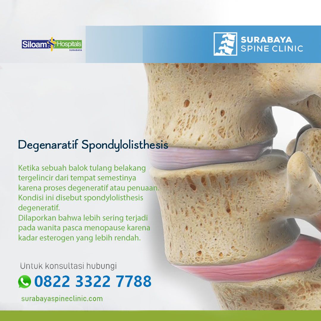 Spondylolisthesis 